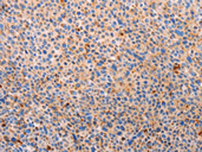 The image on the left is immunohistochemistry of paraffin-embedded Human liver cancer tissue using CSB-PA065885(PLIN2 Antibody) at dilution 1/20, on the right is treated with synthetic peptide. (Original magnification: ×200)
