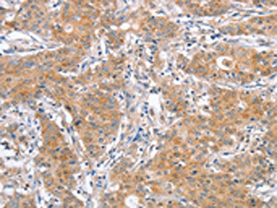The image on the left is immunohistochemistry of paraffin-embedded Human gastic cancer tissue using CSB-PA065886(ATG12 Antibody) at dilution 1/40, on the right is treated with fusion protein. (Original magnification: ×200)
