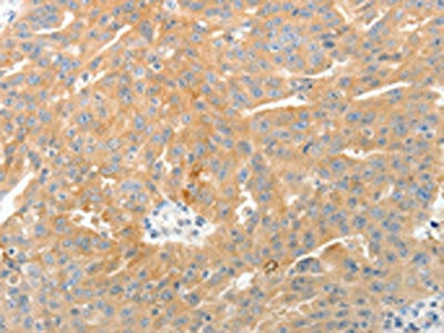 The image on the left is immunohistochemistry of paraffin-embedded Human ovarian cancer tissue using CSB-PA065888(TEP1 Antibody) at dilution 1/50, on the right is treated with synthetic peptide. (Original magnification: ×200)