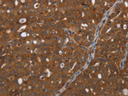 The image on the left is immunohistochemistry of paraffin-embedded Human ovarian cancer tissue using CSB-PA066115(HDAC7 Antibody) at dilution 1/20, on the right is treated with synthetic peptide. (Original magnification: ×200)