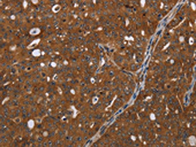 The image on the left is immunohistochemistry of paraffin-embedded Human ovarian cancer tissue using CSB-PA066115(HDAC7 Antibody) at dilution 1/20, on the right is treated with synthetic peptide. (Original magnification: ×200)