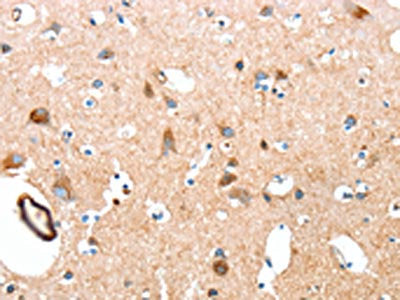 The image on the left is immunohistochemistry of paraffin-embedded Human brain tissue using CSB-PA066208(AARS Antibody) at dilution 1/50, on the right is treated with synthetic peptide. (Original magnification: ×200)