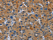 The image on the left is immunohistochemistry of paraffin-embedded Human liver cancer tissue using CSB-PA066219(MSH5 Antibody) at dilution 1/30, on the right is treated with fusion protein. (Original magnification: ×200)