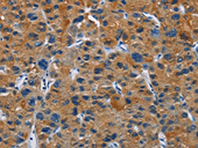 The image on the left is immunohistochemistry of paraffin-embedded Human liver cancer tissue using CSB-PA066219(MSH5 Antibody) at dilution 1/30, on the right is treated with fusion protein. (Original magnification: ×200)