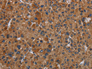 The image on the left is immunohistochemistry of paraffin-embedded Human liver cancer tissue using CSB-PA066346(OMG Antibody) at dilution 1/30, on the right is treated with synthetic peptide. (Original magnification: ×200)