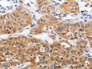 The image on the left is immunohistochemistry of paraffin-embedded Human lung cancer tissue using CSB-PA066436(YWHAG Antibody) at dilution 1/50, on the right is treated with synthetic peptide. (Original magnification: ×200)