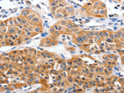 The image on the left is immunohistochemistry of paraffin-embedded Human lung cancer tissue using CSB-PA066436(YWHAG Antibody) at dilution 1/50, on the right is treated with synthetic peptide. (Original magnification: ×200)
