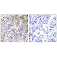 Immunohistochemistry analysis of paraffin-embedded human liver carcinoma tissue using ACOT12 antibody.