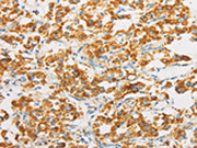 The image on the left is immunohistochemistry of paraffin-embedded Human thyroid cancer tissue using CSB-PA066473(IDH3G Antibody) at dilution 1/30, on the right is treated with fusion protein. (Original magnification: ×200)