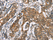 The image on the left is immunohistochemistry of paraffin-embedded Human gastic cancer tissue using CSB-PA066517(ADGRB2 Antibody) at dilution 1/25, on the right is treated with synthetic peptide. (Original magnification: ×200)