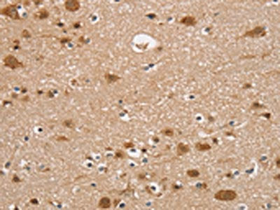 The image on the left is immunohistochemistry of paraffin-embedded Human brain tissue using CSB-PA066534(RUNX1T1 Antibody) at dilution 1/35, on the right is treated with synthetic peptide. (Original magnification: ×200)