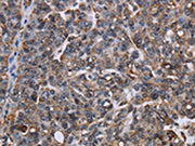 The image on the left is immunohistochemistry of paraffin-embedded Human ovarian cancer tissue using CSB-PA066576(LDOC1 Antibody) at dilution 1/50, on the right is treated with fusion protein. (Original magnification: ×200)