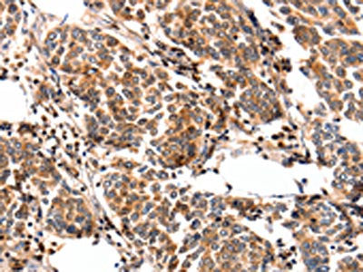 The image on the left is immunohistochemistry of paraffin-embedded Human breast cancer tissue using CSB-PA066650(FABP7 Antibody) at dilution 1/25, on the right is treated with fusion protein. (Original magnification: ×200)