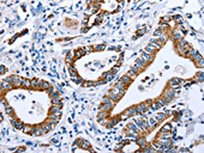The image on the left is immunohistochemistry of paraffin-embedded Human stomach cancer tissue using CSB-PA066716(CPT1A Antibody) at dilution 1/25, on the right is treated with fusion protein. (Original magnification: ×200)