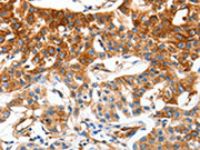 The image on the left is immunohistochemistry of paraffin-embedded Human lung cancer tissue using CSB-PA066991(MCAM Antibody) at dilution 1/50, on the right is treated with synthetic peptide. (Original magnification: ×200)
