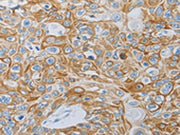The image on the left is immunohistochemistry of paraffin-embedded Human esophagus cancer tissue using CSB-PA067089(MC5R Antibody) at dilution 1/60, on the right is treated with synthetic peptide. (Original magnification: ×200)
