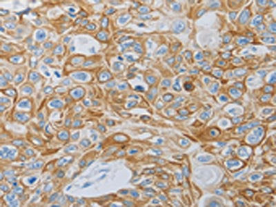 The image on the left is immunohistochemistry of paraffin-embedded Human esophagus cancer tissue using CSB-PA067089(MC5R Antibody) at dilution 1/60, on the right is treated with synthetic peptide. (Original magnification: ×200)