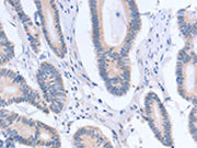 The image on the left is immunohistochemistry of paraffin-embedded Human colon cancer tissue using CSB-PA067150(ACTR3B Antibody) at dilution 1/15, on the right is treated with fusion protein. (Original magnification: ×200)