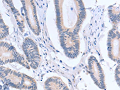 The image on the left is immunohistochemistry of paraffin-embedded Human colon cancer tissue using CSB-PA067150(ACTR3B Antibody) at dilution 1/15, on the right is treated with fusion protein. (Original magnification: ×200)