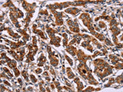 The image on the left is immunohistochemistry of paraffin-embedded Human breast cancer tissue using CSB-PA067380(ID2 Antibody) at dilution 1/30, on the right is treated with synthetic peptide. (Original magnification: ×200)