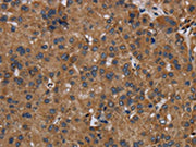 The image on the left is immunohistochemistry of paraffin-embedded Human liver cancer tissue using CSB-PA067561(NDUFS8 Antibody) at dilution 1/50, on the right is treated with fusion protein. (Original magnification: ×200)
