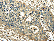 The image on the left is immunohistochemistry of paraffin-embedded Human esophagus cancer tissue using CSB-PA067622(PKM Antibody) at dilution 1/25, on the right is treated with synthetic peptide. (Original magnification: ×200)
