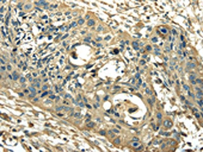 The image on the left is immunohistochemistry of paraffin-embedded Human esophagus cancer tissue using CSB-PA067622(PKM Antibody) at dilution 1/25, on the right is treated with synthetic peptide. (Original magnification: ×200)