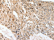 The image on the left is immunohistochemistry of paraffin-embedded Human esophagus cancer tissue using CSB-PA067798(SLC1A7 Antibody) at dilution 1/60, on the right is treated with synthetic peptide. (Original magnification: ×200)
