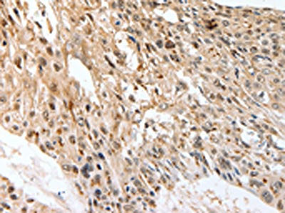 The image on the left is immunohistochemistry of paraffin-embedded Human esophagus cancer tissue using CSB-PA067798(SLC1A7 Antibody) at dilution 1/60, on the right is treated with synthetic peptide. (Original magnification: ×200)