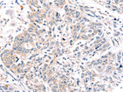 The image on the left is immunohistochemistry of paraffin-embedded Human lung cancer tissue using CSB-PA067964(ROR1 Antibody) at dilution 1/45, on the right is treated with synthetic peptide. (Original magnification: ×200)