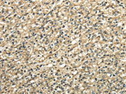 The image on the left is immunohistochemistry of paraffin-embedded Human prostate cancer tissue using CSB-PA067976(TUBA1C Antibody) at dilution 1/25, on the right is treated with fusion protein. (Original magnification: ×200)