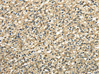 The image on the left is immunohistochemistry of paraffin-embedded Human prostate cancer tissue using CSB-PA067976(TUBA1C Antibody) at dilution 1/25, on the right is treated with fusion protein. (Original magnification: ×200)