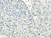 The image on the left is immunohistochemistry of paraffin-embedded Human breast cancer tissue using CSB-PA068002(VPS36 Antibody) at dilution 1/40, on the right is treated with synthetic peptide. (Original magnification: ×200)