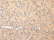The image on the left is immunohistochemistry of paraffin-embedded Human liver cancer tissue using CSB-PA068096(COL8A2 Antibody) at dilution 1/20, on the right is treated with synthetic peptide. (Original magnification: ×200)
