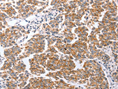 The image on the left is immunohistochemistry of paraffin-embedded Human breast cancer tissue using CSB-PA068230(CLDN3 Antibody) at dilution 1/25, on the right is treated with synthetic peptide. (Original magnification: ×200)