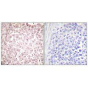 Immunohistochemical analysis of paraffin-embedded human breast carcinoma tissue using RCC1 antibody.