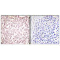 Immunohistochemical analysis of paraffin-embedded human breast carcinoma tissue using RCC1 antibody.