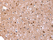The image on the left is immunohistochemistry of paraffin-embedded Human brain tissue using CSB-PA068354(FAT1 Antibody) at dilution 1/20, on the right is treated with synthetic peptide. (Original magnification: ×200)