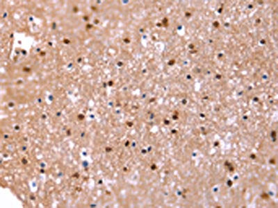 The image on the left is immunohistochemistry of paraffin-embedded Human brain tissue using CSB-PA068354(FAT1 Antibody) at dilution 1/20, on the right is treated with synthetic peptide. (Original magnification: ×200)