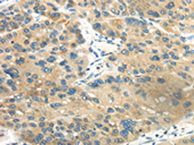 The image on the left is immunohistochemistry of paraffin-embedded Human liver cancer tissue using CSB-PA068483(CD70 Antibody) at dilution 1/40, on the right is treated with synthetic peptide. (Original magnification: ×200)