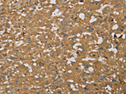 The image on the left is immunohistochemistry of paraffin-embedded Human thyroid cancer tissue using CSB-PA068521(AHSG Antibody) at dilution 1/60, on the right is treated with fusion protein. (Original magnification: ×200)