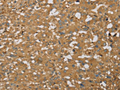The image on the left is immunohistochemistry of paraffin-embedded Human thyroid cancer tissue using CSB-PA068521(AHSG Antibody) at dilution 1/60, on the right is treated with fusion protein. (Original magnification: ×200)