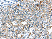 The image on the left is immunohistochemistry of paraffin-embedded Human breast cancer tissue using CSB-PA068526(TTBK1 Antibody) at dilution 1/35, on the right is treated with synthetic peptide. (Original magnification: ×200)
