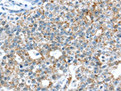 The image on the left is immunohistochemistry of paraffin-embedded Human breast cancer tissue using CSB-PA068526(TTBK1 Antibody) at dilution 1/35, on the right is treated with synthetic peptide. (Original magnification: ×200)