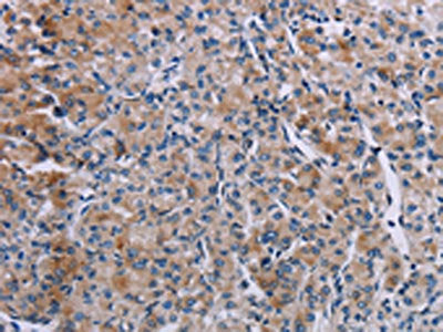 The image on the left is immunohistochemistry of paraffin-embedded Human prostate cancer tissue using CSB-PA068591(KDM4D Antibody) at dilution 1/60, on the right is treated with fusion protein. (Original magnification: ×200)
