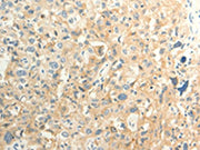 The image on the left is immunohistochemistry of paraffin-embedded Human esophagus cancer tissue using CSB-PA068600(FAT3 Antibody) at dilution 1/30, on the right is treated with synthetic peptide. (Original magnification: ×200)