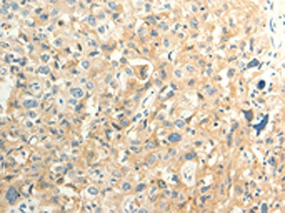 The image on the left is immunohistochemistry of paraffin-embedded Human esophagus cancer tissue using CSB-PA068600(FAT3 Antibody) at dilution 1/30, on the right is treated with synthetic peptide. (Original magnification: ×200)