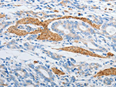 The image on the left is immunohistochemistry of paraffin-embedded Human gastic cancer tissue using CSB-PA068736(PDX1 Antibody) at dilution 1/20, on the right is treated with synthetic peptide. (Original magnification: ×200)