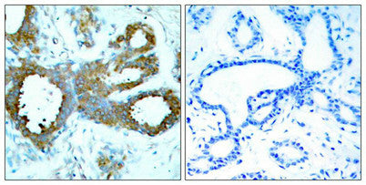 Immunohistochemical analysis of paraffin-embedded human breast carcinoma tissue using PAK1/PAK2/PAK3(Phospho-Thr423/Thr402/Thr421) Antibody(left) or the same antibody preincubated with blocking peptide(right).