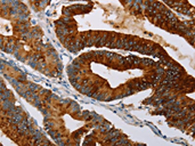 The image on the left is immunohistochemistry of paraffin-embedded Human colon cancer tissue using CSB-PA069176(TFF3 Antibody) at dilution 1/35, on the right is treated with fusion protein. (Original magnification: ×200)